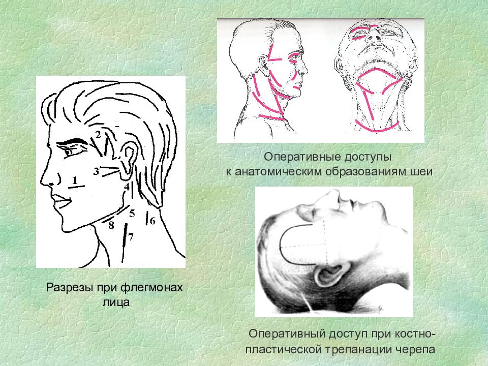 Разрезы при флегмонах шеи топографическая анатомия. Разрезы при операциях на шее. Оперативная хирургия шеи.