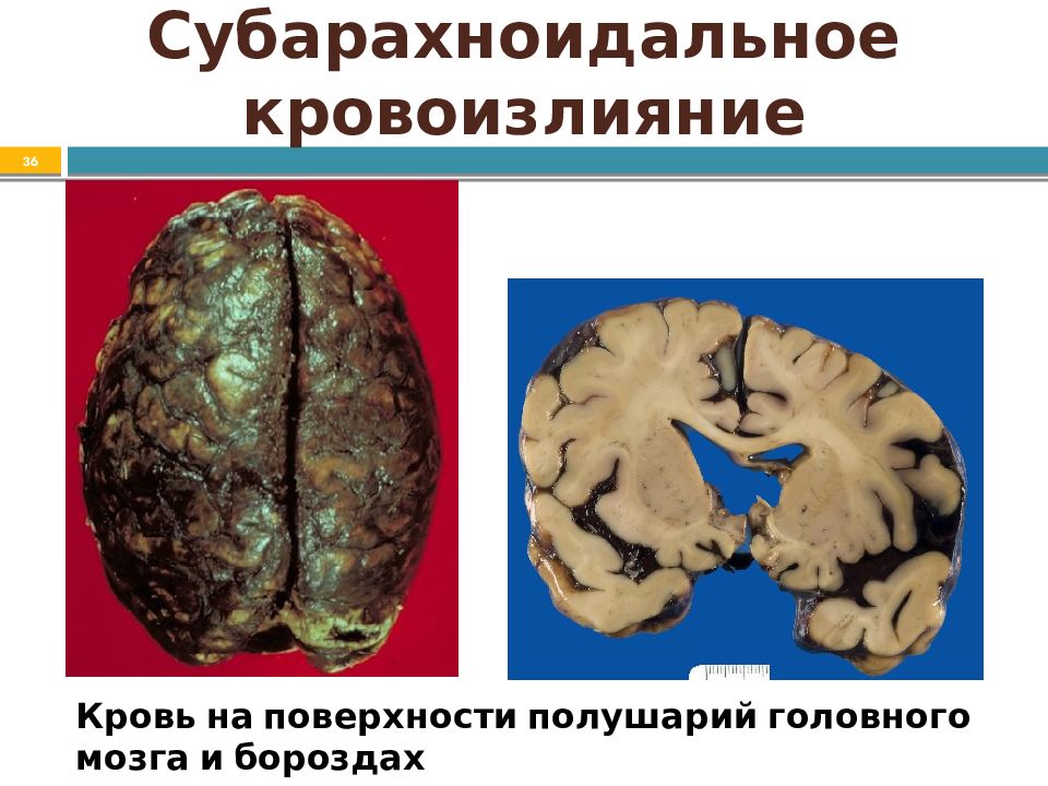 Как выглядит мозг после инсульта Кровоизлияние в мозг - CollectPhoto.ru