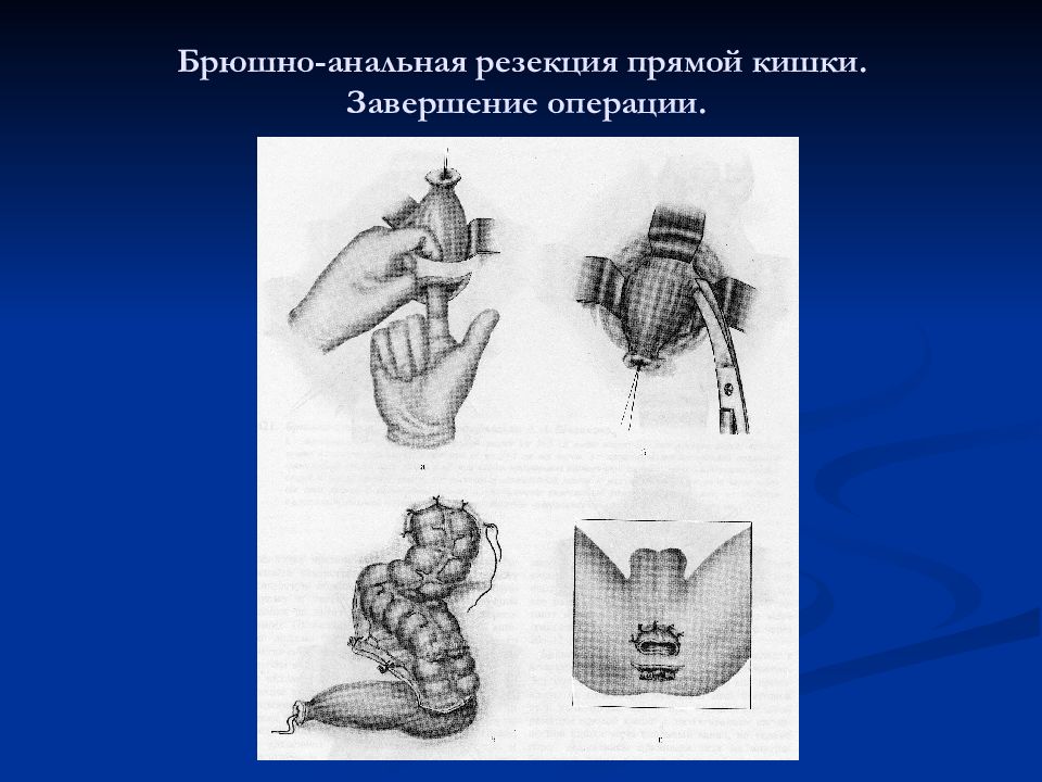 Завершение операции. Брюшно анальная резекция прямой кишки. Передняя резекция прямой кишки. Брюшно промежностная резекция.