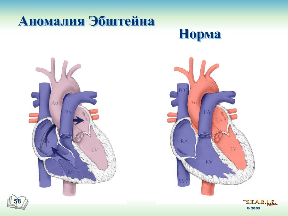 Двухкамерное сердце рисунок. Аномалия Эбштейна гемодинамика. Болезнь Эбштейна гемодинамика. Аномалия Эбштейна сердца. Аномалия Эбштейна у новорожденного.