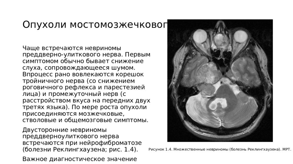 Опухоли нервной системы неврология презентация