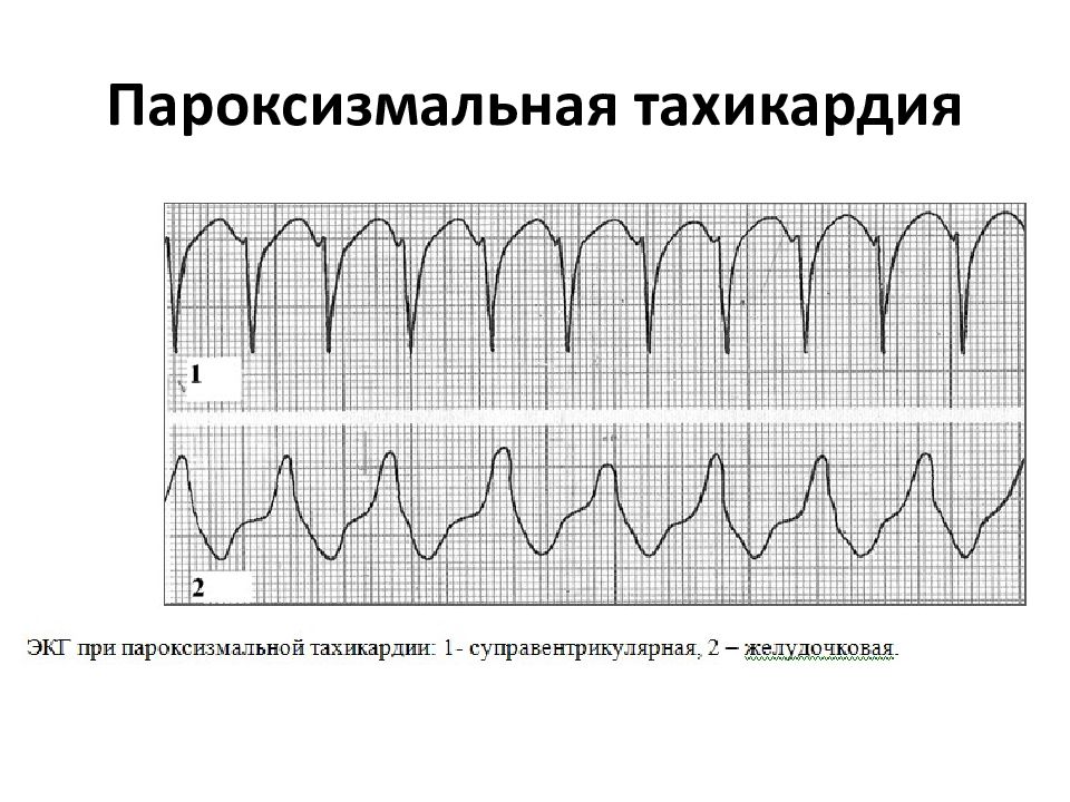 Пароксизмальная тахикардия это. Пароксизмальная тахикардия ЭКГ. ЭКГ при пароксизмальной тахикардии. Наджелудочковая тахикардия пароксизмальная форма. Пароксизмальная наджелудочковая тахикардия ЭКГ рисунок.