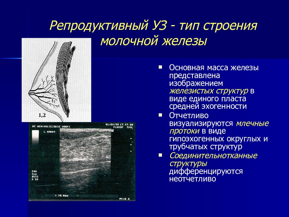 Молочная железа норма. Молочная железа Тип строения с. Типы строения молочных желез по УЗИ. Тип строения молочной железы по ACR. Типы строения молочных желез на УЗИ.