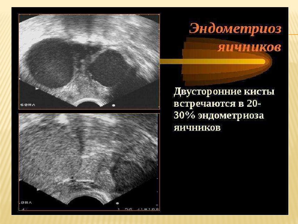 Признаки кисты. Эндометриоидная киста яичника. Эндометриоидная киста макропрепарат. Эндометриоидная киста яичника диагноз. Эндометриоидная киста яичника на УЗИ.