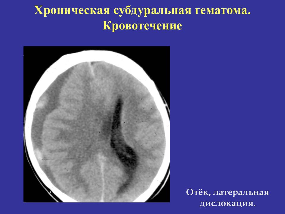 Субдуральная гематома. Субдуральная гематома 10мл. Хроническая субдуральная гематома на кт. Субдуральная гематома рентгенограмма. Хронические субдуральные гематомы.