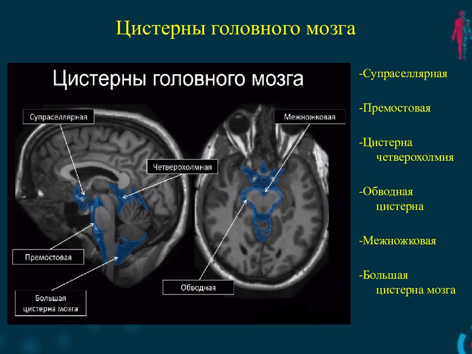 Цистерны мозга расширены. Базальные цистерны головного мозга кт анатомия. Межножковая цистерна мрт. Супраселлярная цистерна мрт. Цистерна Меккеля головной мозг.