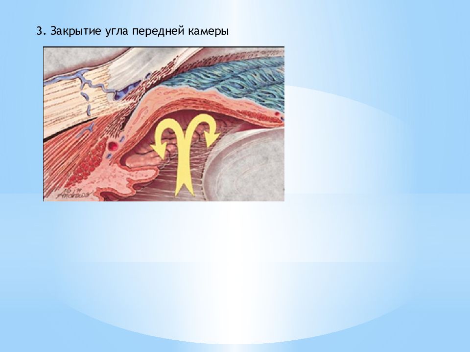 Закрытый угол. Нарушение гидродинамики глаза. Причины нарушения гидродинамики глаза. Закрытый угол передней камеры. Гемо и гидродинамики глаза.
