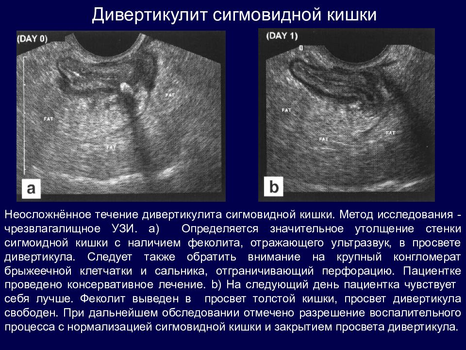 Перед узи кишечника