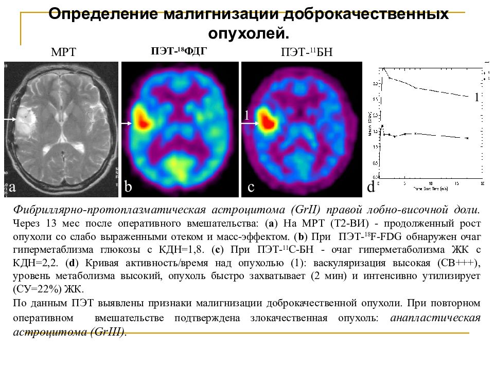 Пэт с тирозином. ПЭТ кт накопление ФДГ. ПЭТ-кт головного мозга с 18 ФДГ. ПЭТ кт головной мозг с ФДГ.