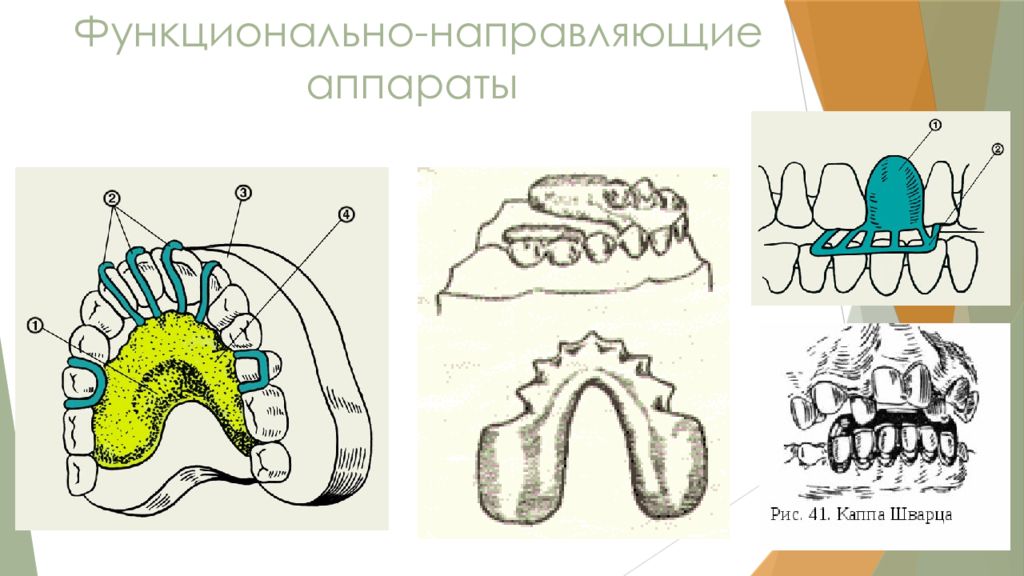 Функционально. Функционально направляющие аппараты в ортодонтии. Функционально направляющий аппарат Шварца. Функционально направляющие пластиночный аппарат Шварца. Аппарат Катца ортодонтия пластинка Шварца.