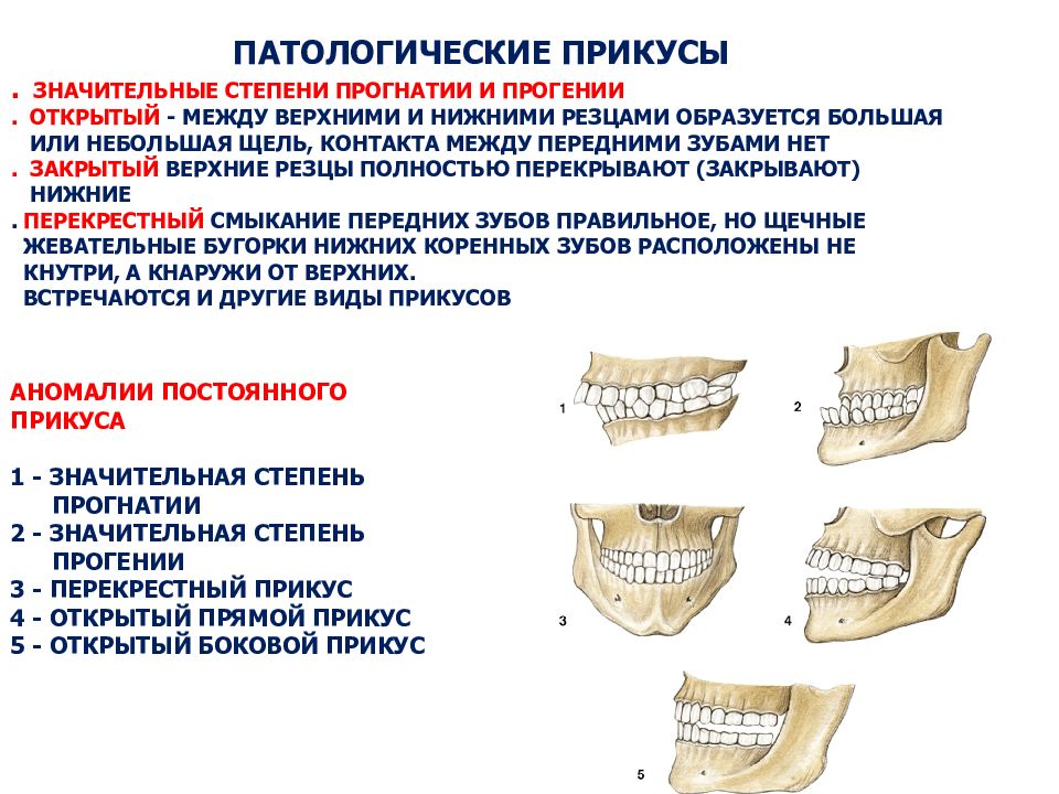 Прогения нижней челюсти