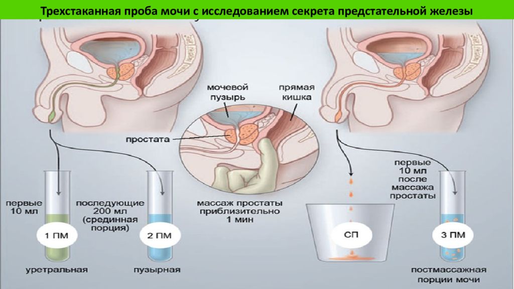 Предстательная железа сок