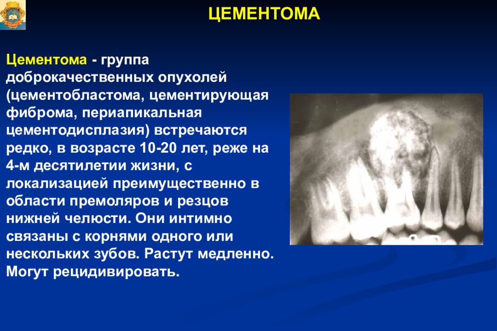 Доброкачественные одонтогенные опухоли презентация