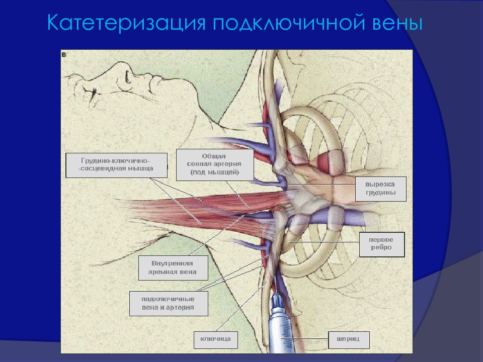 Установить вена. Подключичная Вена катетеризация. Подключичная Вена анатомия. Подключичная Вена топографическая анатомия. Подключичная Вена – Vena subclavia.