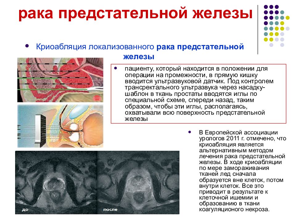 Рак предстательной железы презентация по урологии