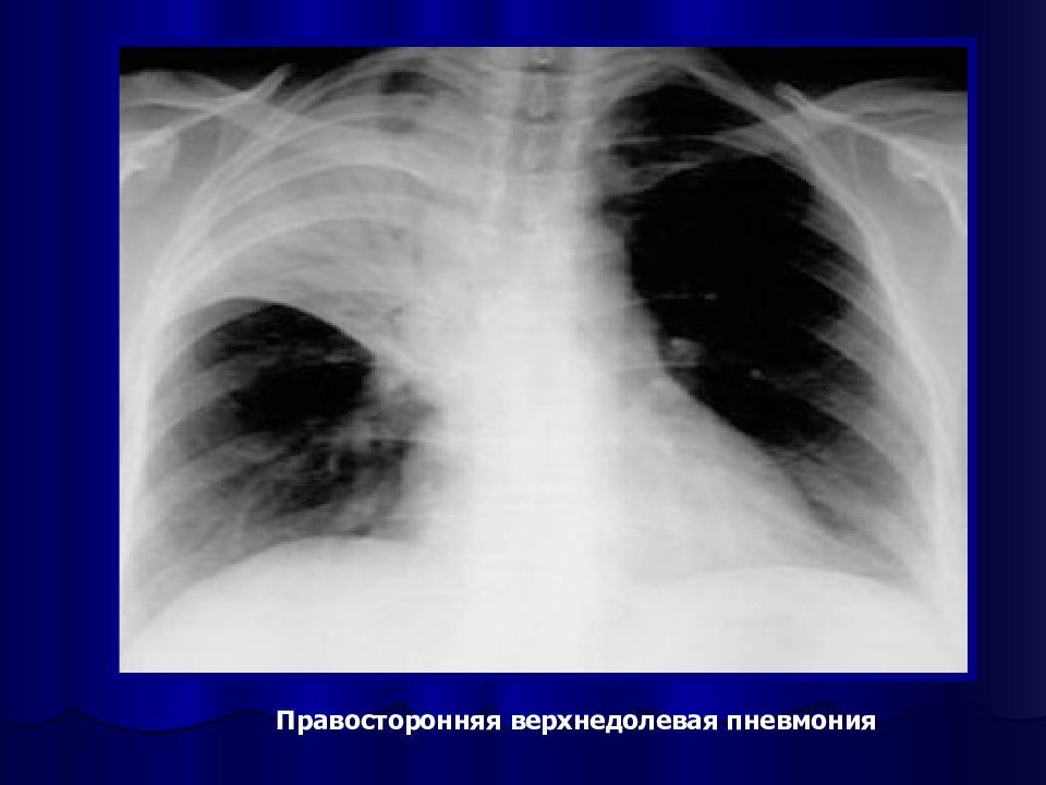 Верхнедолевая пневмония. Рентген верхнедолевой правосторонней пневмонии. Нижнедолевая крупозная пневмония. Правосторонняя очаговая пневмония рентген. Рентген пневмонии осложненной экссудативным плевритом.