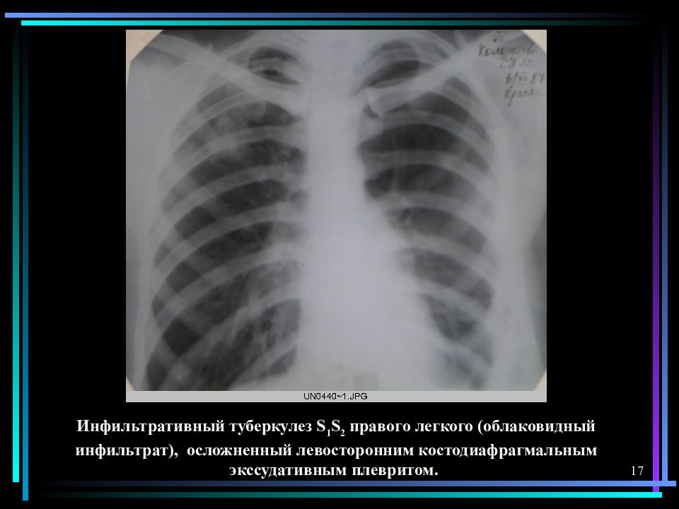 Инфильтративный туберкулез легких презентация