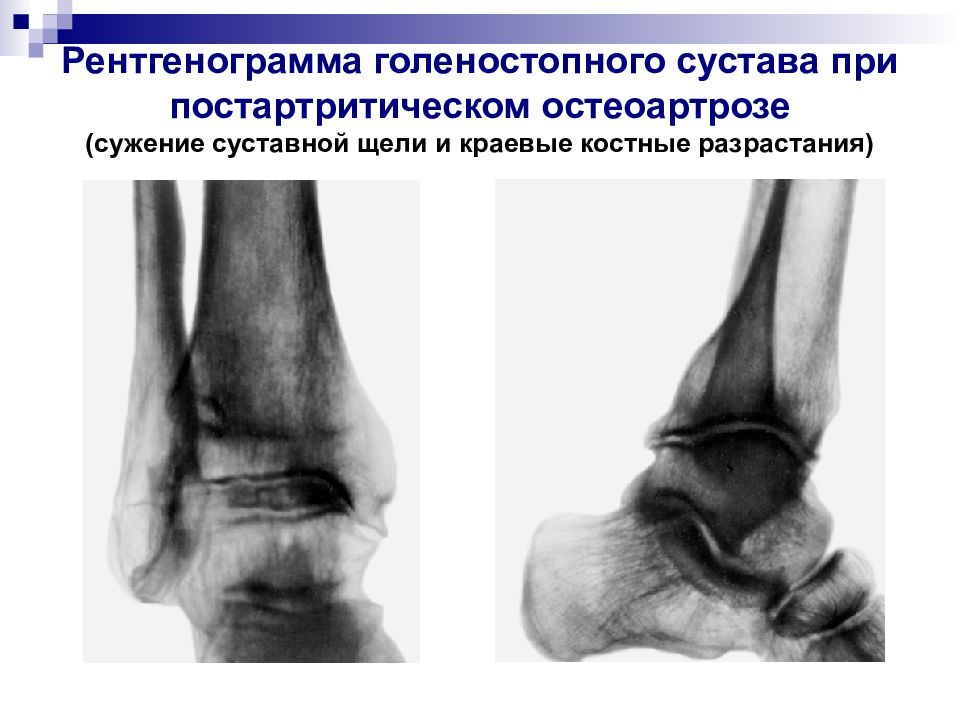 Суставная щель голеностопного сустава