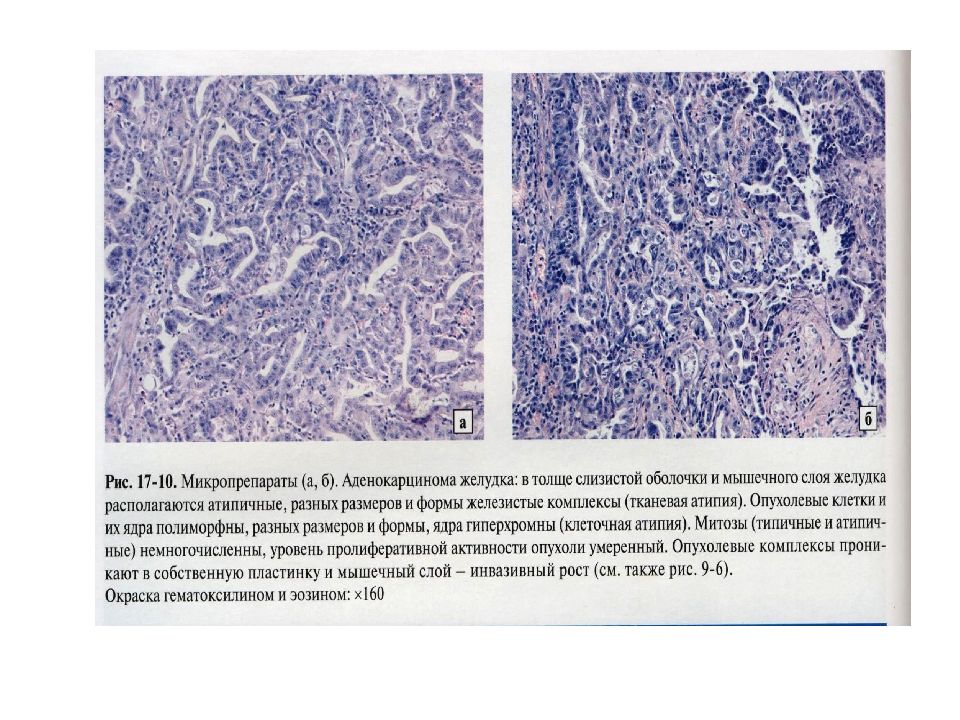 Микропрепарат аденокарцинома желудка рисунок