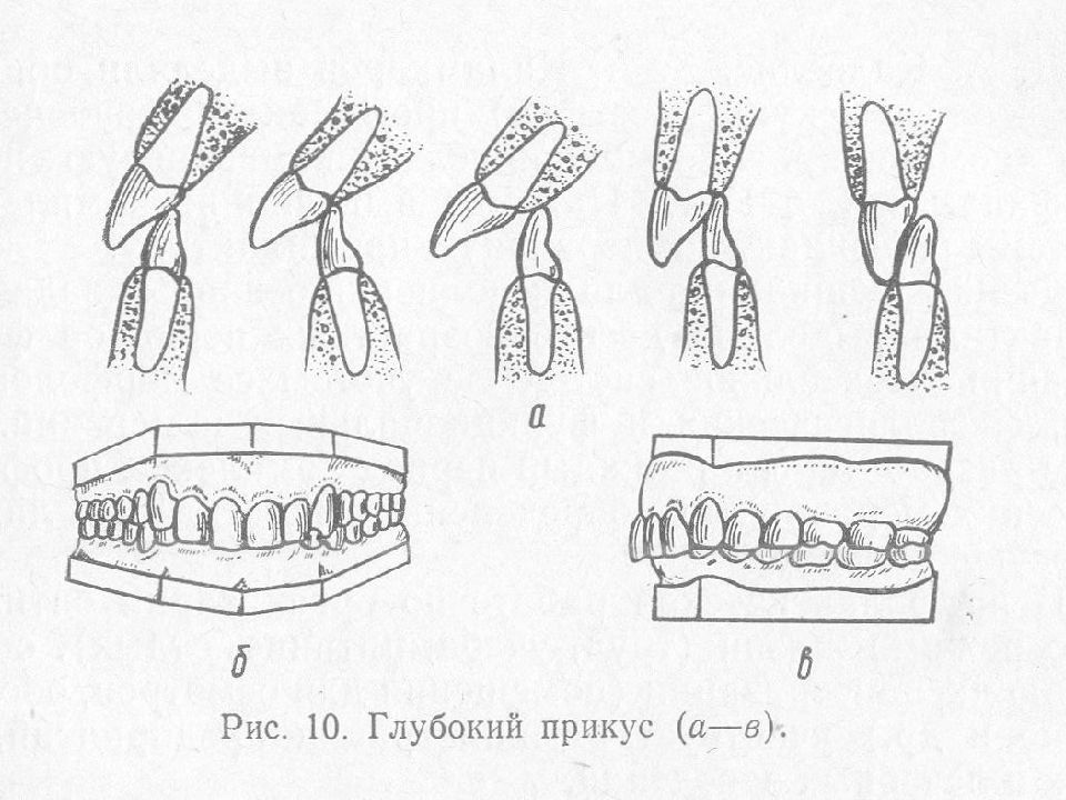 Виды глубокие. Глубокий прикус вид сбоку. Глубокая резцовая окклюзия схема. Аномалии прикуса с глубоким резцовым перекрытием. Прикус с глубоким резцовым перекрытием.