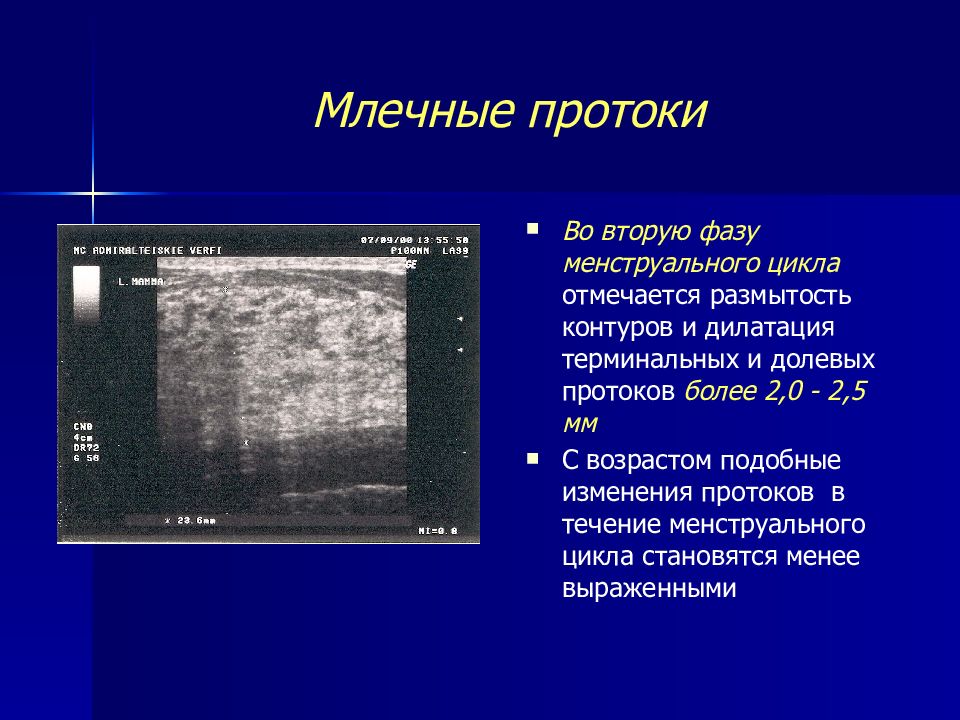 Узи молочной железы цикл. Норма млечных протоков на УЗИ. Млечные протоки молочной железы на УЗИ. Нормы протоков молочной железы на УЗИ. Расширение млечных протоков молочной железы по УЗИ.