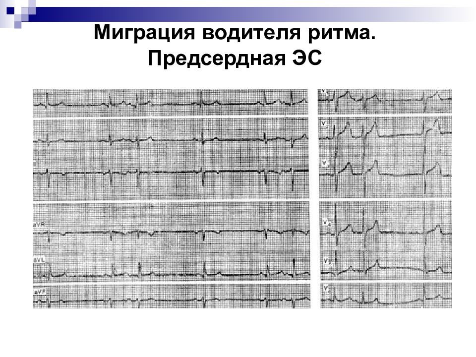 Миграция водителя ритма