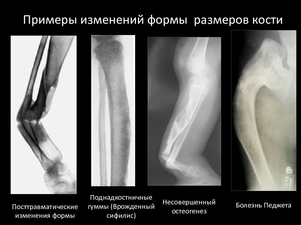 Изменение формы кости. Изменение формы костей. Лучевая семиотика заболеваний костно-суставной системы. Изменений формы кости рентген. Изменение длины кости рентген.