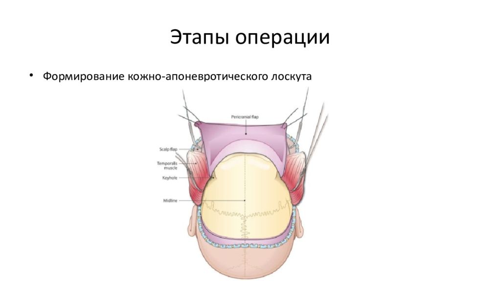 Формирование операций. Формирование кожно-апоневротического лоскута. Декомпрессивная краниэктомия. Этапы операции презентация. Формирование кожного лоскута.