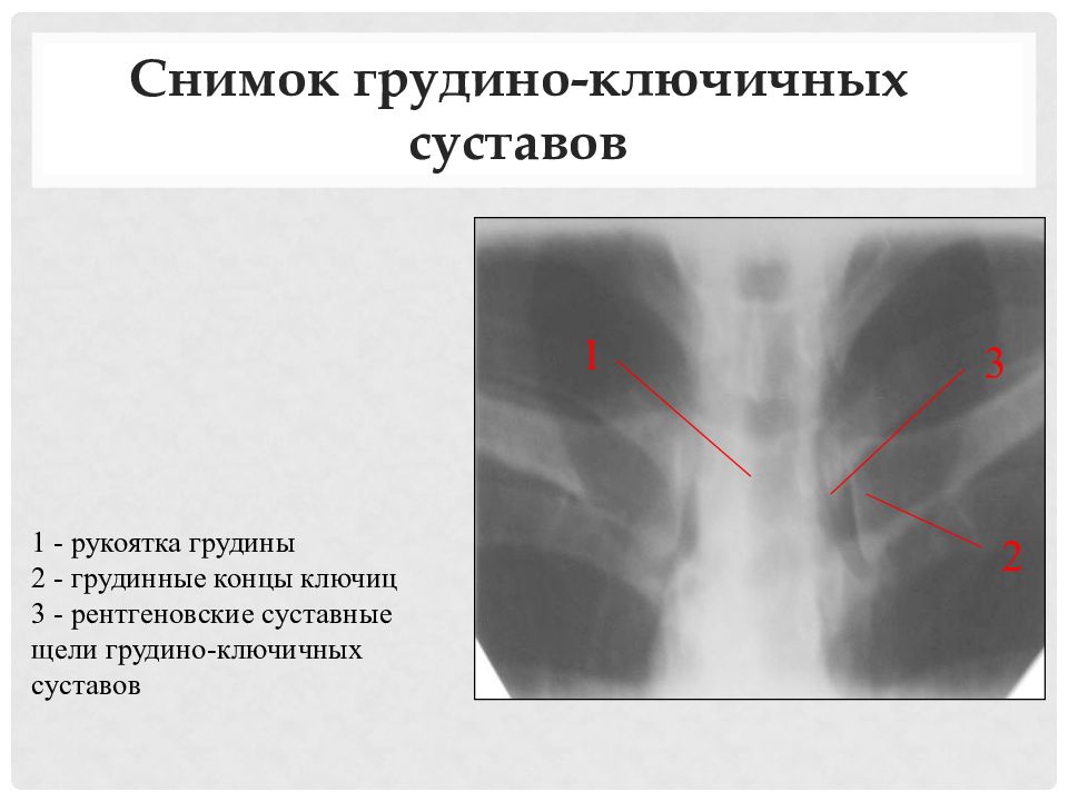 Грудинно ключичное сочленение. Грудино ключичное сочленение. Травма грудино ключичного сочленения. Грудино-ключичное сочленение рентген укладка. Артроз грудино-ключичного сочленения.