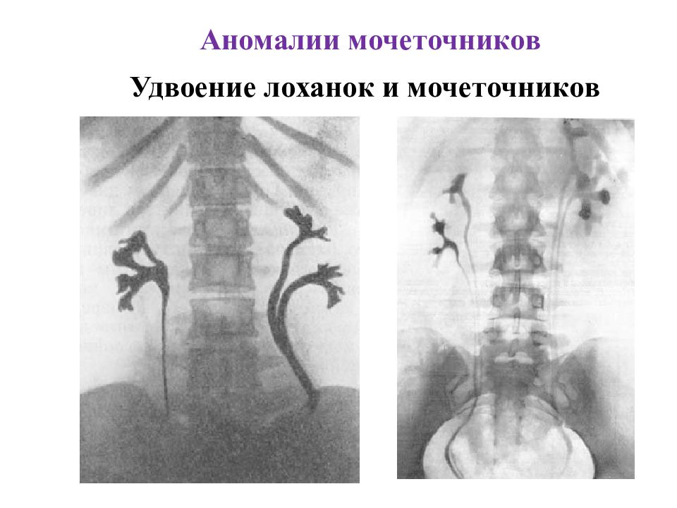 Аномалия развития почек презентация