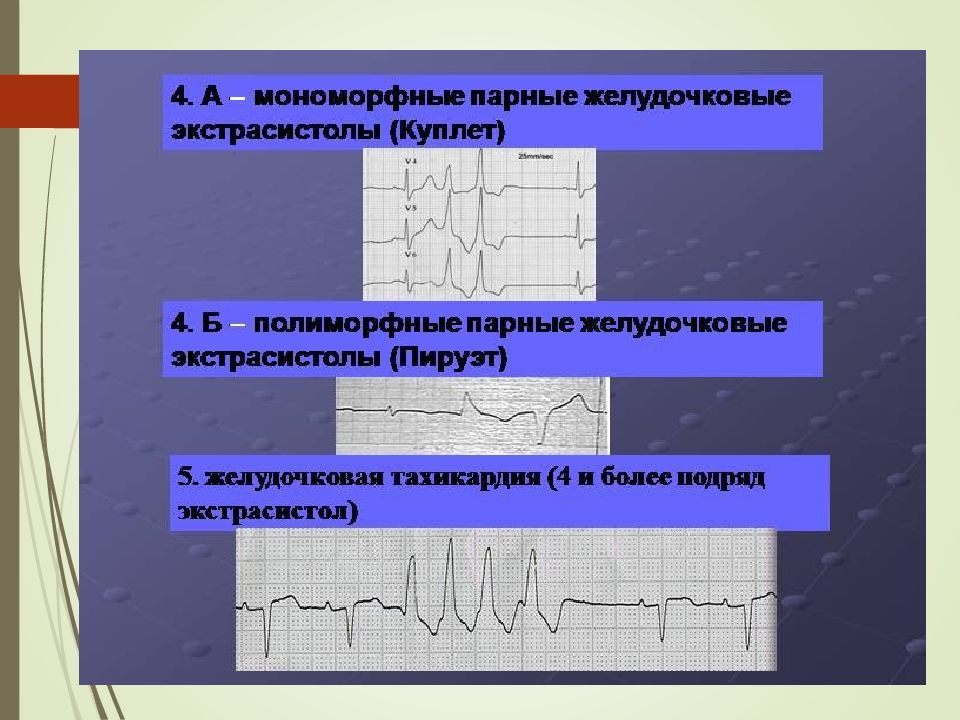 Клиническая картина желудочковой экстрасистолии