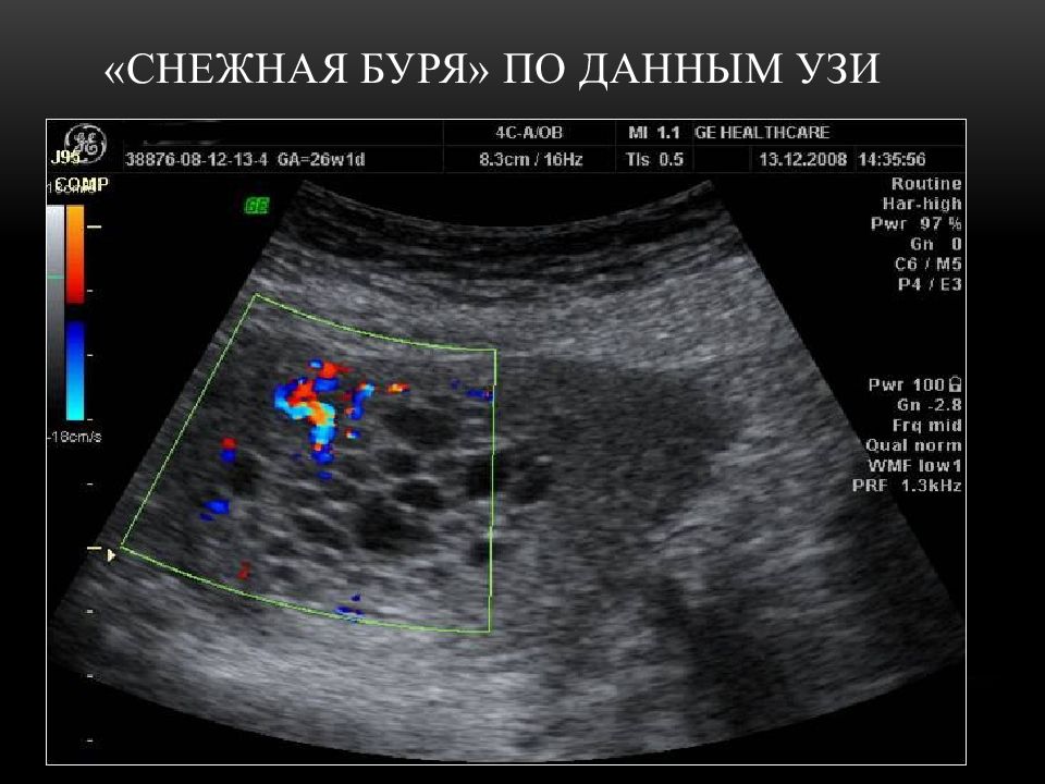 Уз картина. Трофобластическая болезнь УЗИ. Трофобластическая болезнь УЗИ картина. Трофобластическая опухоль плацентарного ложа УЗИ. Симптом снежной бури на УЗИ.