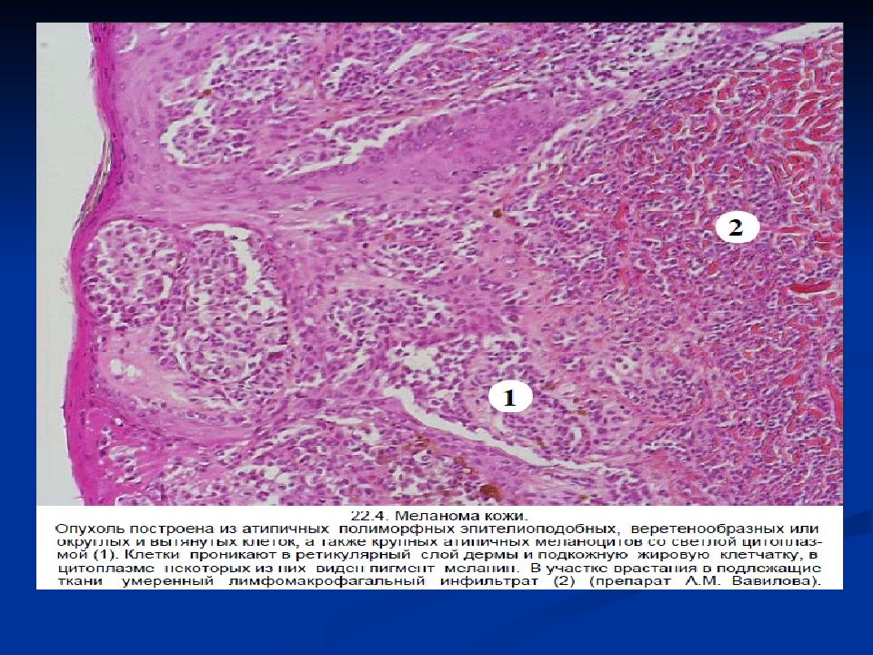 Опухоли меланинобразующей ткани презентация