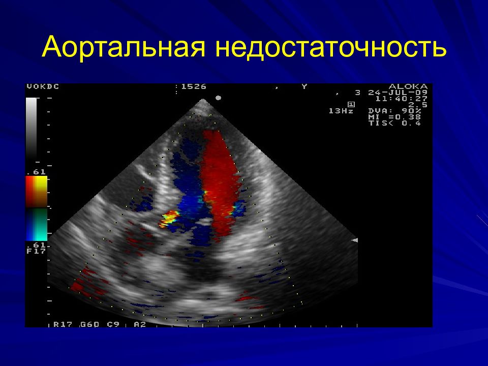 Аортальный градиент. Аортальный стеноз ЭХОКГ. Митральная недостаточность Эхо. Аортальная недостаточность ЭХОКГ. Аортальная регургитация на ЭХОКГ.