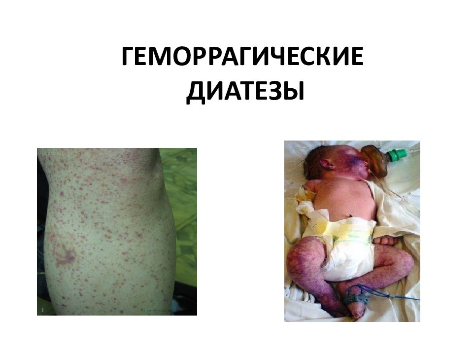 ГЕМОРРАГИЧЕСКИЕ ДИАТЕЗЫ