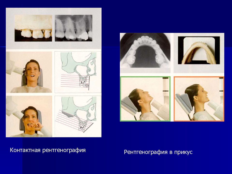Рентгенография в эндодонтии презентация