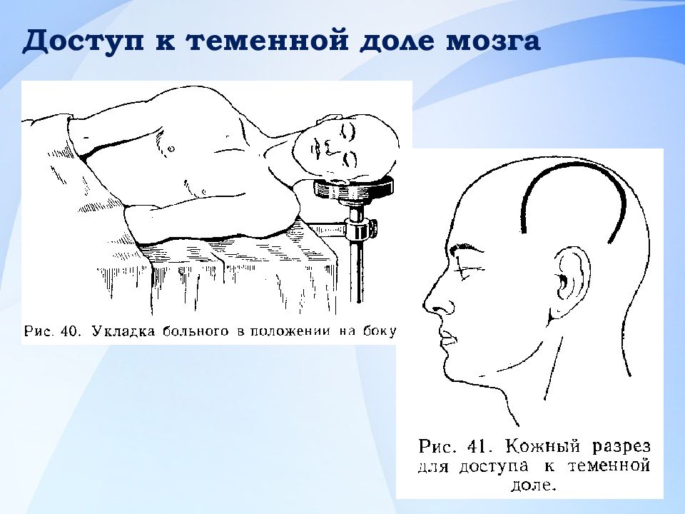 Трепанация зачем. Трепанация черепа операция. Трепанация черепа головного мозга. Трепанация черепа трупа.