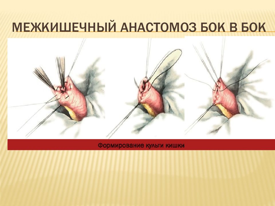 Анастомоз конец в конец