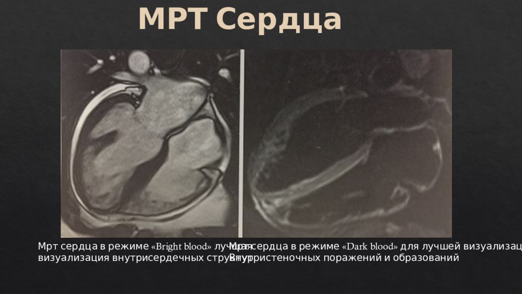 Мрт сердца. Мрт сердца и коронарных сосудов. Мрт сердца презентация.