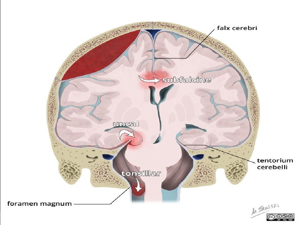 Киста желудочка головного мозга. Внутричерепная гипертензия презентация. Внутричерепная гипертензия на кт. Внутричерепные мембраны. Внутричерепные протоки.