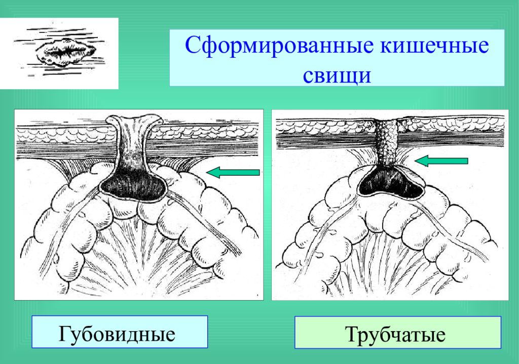 Кишечный свищ