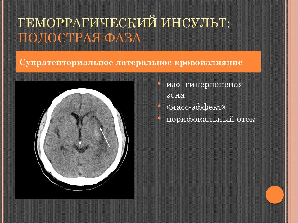 Геморрагический инсульт. Геморрагический инсульт (мрт-сканирование). Подострый геморрагический инсульт кт. Геморрагический инсульт головного мозга кт. Стадии геморрагического инсульта кт.