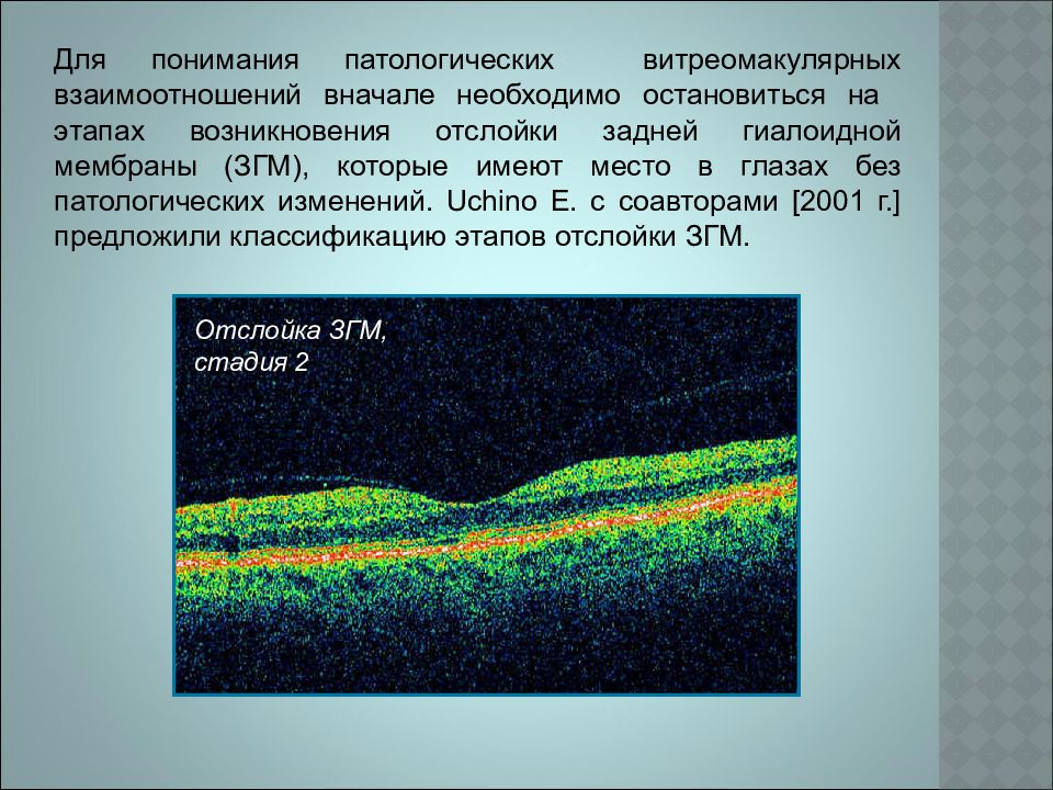 Нормальная область. Оптическая когерентная томография макулярной области. Отслойка задней гиалоидной. Отслойка гиалоидной мембраны. Отслойка задней гиалоидной мембраны.