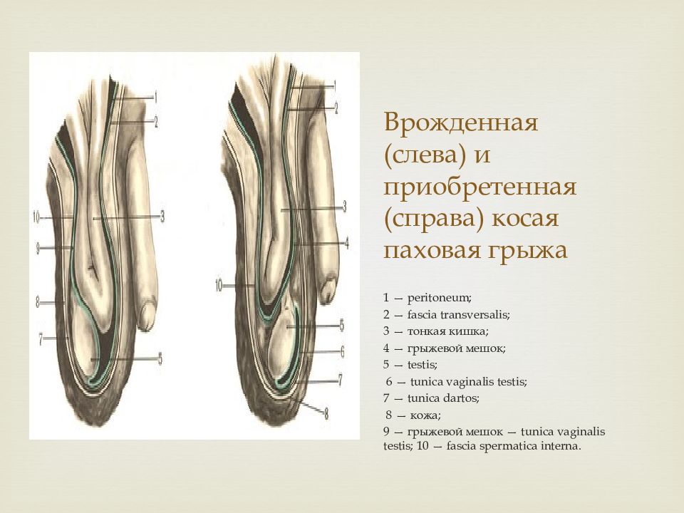 Косая и прямая паховая грыжа отличие. Врожденная и приобретенная паховая грыжа. Врожденная и приобретенная косая паховая грыжа. Косая приобретенная паховая грыжа. Косая паховая грыжа хирургическая анатомия.