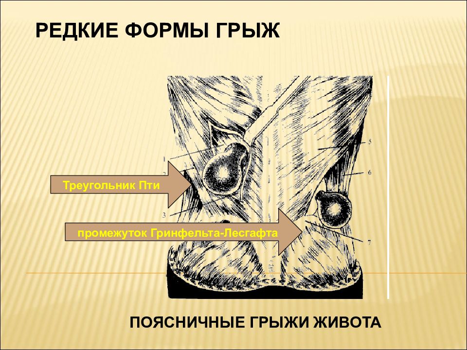 Презентация по грыжам живота