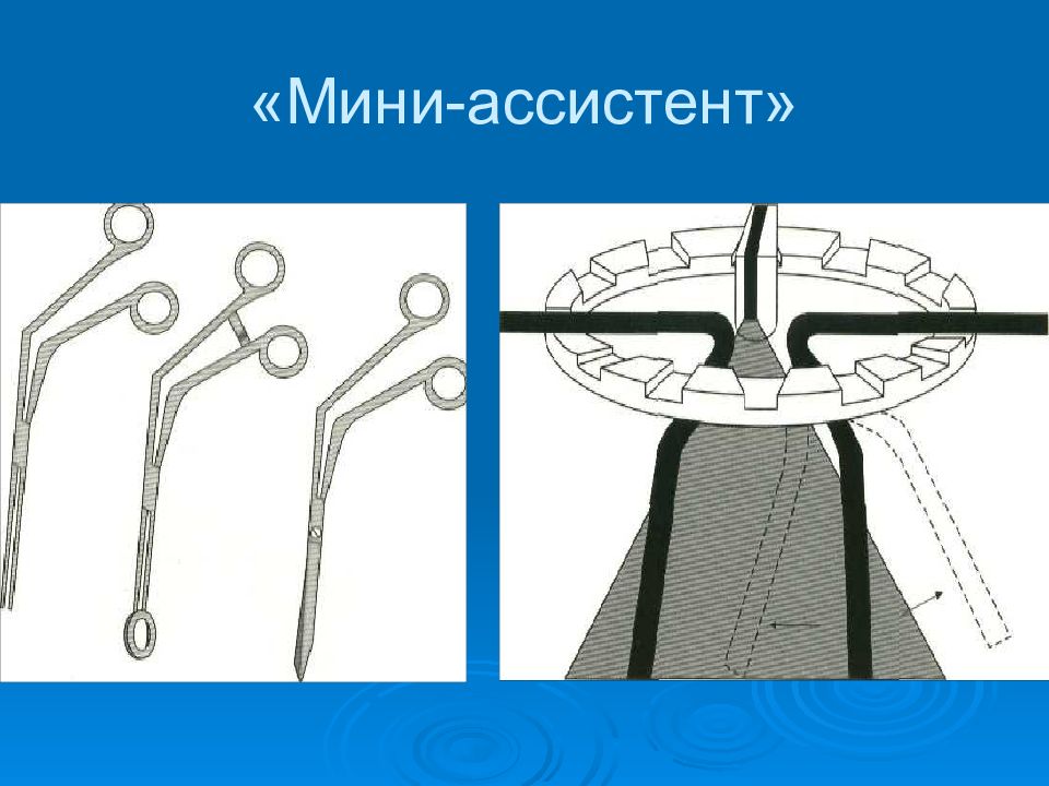 Набор ассистентов. Инструментов «мини-ассистент»,. Аппарат мини ассистент. Кольцо Пруткова мини ассистент. Мини ассистент для холецистэктомии.