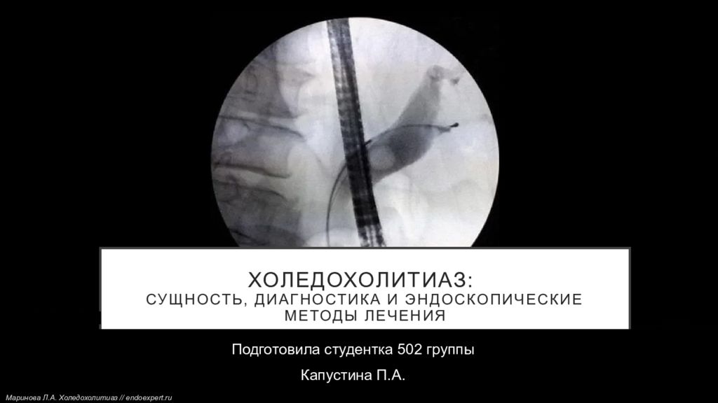 Холедохолитиаз : сущность, диагностика и эндоскопические методы лечения
