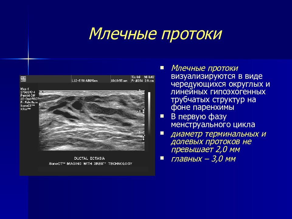 Молочные железы женщины узи. Норма млечных протоков на УЗИ. Млечные протоки в менопаузе по УЗИ. Расширение млечных протоков молочной железы по УЗИ. Расширение протоков молочной железы на УЗИ В менопаузе.