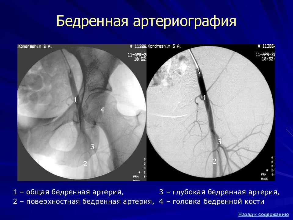 Почечная ангиография презентация