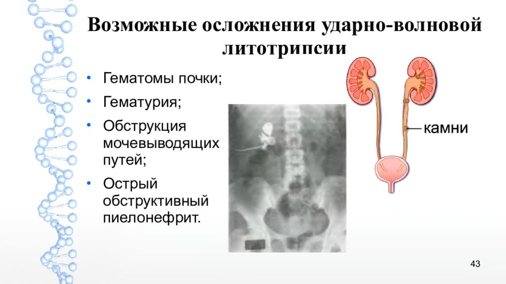 Урологические осложнения. Обструкции нижних мочевых путей. Обструкция мочевыводящих путей. Симптомы обструкции мочевых путей. Симптомы обструкции мочевыводящих путей.